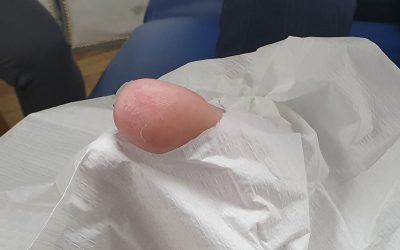 What happens during toenail surgery?